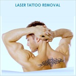 laser tattoo removal